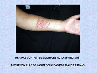 HERIDAS CORTANTES MULTIPLES AUTOINFRINGIDAS
DIFERENCIARLAS DE LAS PRODUCIDAS POR MANOS AJENAS
 