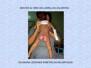 SENTAR AL NIÑO EN LADRILLOS CALIENTES
OCASIONA LESIONES SIMETRICAS DELIMITADAS
 