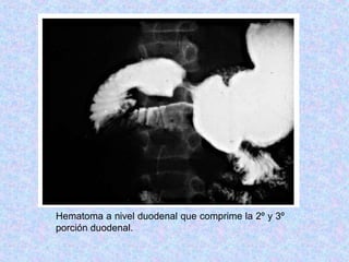 Hematoma a nivel duodenal que comprime la 2º y 3º
porción duodenal.
 