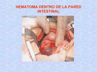 HEMATOMA DENTRO DE LA PARED
INTESTINAL
 