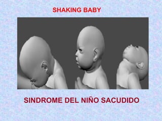 SINDROME DEL NIÑO SACUDIDO
SHAKING BABY
 