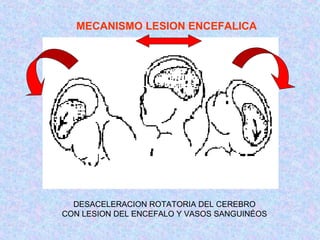 MECANISMO LESION ENCEFALICA
DESACELERACION ROTATORIA DEL CEREBRO
CON LESION DEL ENCEFALO Y VASOS SANGUINÉOS
 
