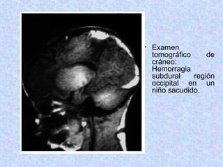 • Examen
tomográfico de
cráneo:
Hemorragia
subdural región
occipital en un
niño sacudido.
 