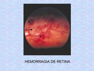 HEMORRAGIA DE RETINA
 