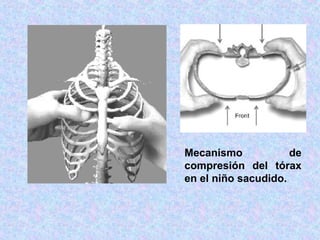 Mecanismo de
compresión del tórax
en el niño sacudido.
 
