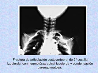 Fractura de articulación costovertebral de 2º costilla
izquierda, con neumotórax apical izquierda y condensación
parenquimatosa.
 