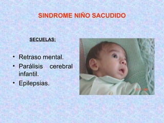 SINDROME NIÑO SACUDIDO
SECUELAS:
• Retraso mental.
• Parálisis cerebral
infantil.
• Epilepsias.
 