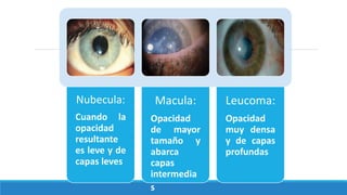 Nubecula:
Cuando la
opacidad
resultante
es leve y de
capas leves
Macula:
Opacidad
de mayor
tamaño y
abarca
capas
intermedia
s
Leucoma:
Opacidad
muy densa
y de capas
profundas
 