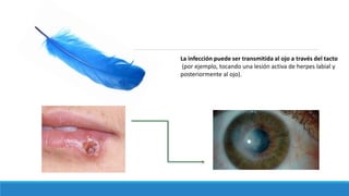 La infección puede ser transmitida al ojo a través del tacto
(por ejemplo, tocando una lesión activa de herpes labial y
posteriormente al ojo).
 