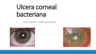 Ulcera corneal
bacteriana
ESAI DANIEL VERA ZACARIAS
 