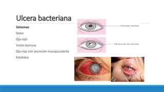 Ulcera bacteriana
Síntomas
Dolor
Ojo rojo
Visión borrosa
Ojo rojo con secreción mucopurulenta
fotofobia
 