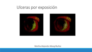 Ulceras por exposición
Martha Alejandra Wong Muñoz
 