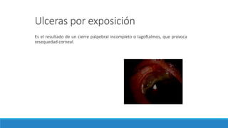 Ulceras por exposición
Es el resultado de un cierre palpebral incompleto o lagoftalmos, que provoca
resequedad corneal.
 