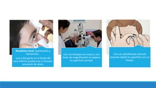 Anestésico local (pantocaína y
tetracaína) :
una o dos gotas en el fondo del
saco inferior produce en 2 minutos
sensación de alivio.
Con una lámpara en mano y una
lente de magnificación se explora
la superficie corneal.
Una vez identificado retirarlo
tocando rápido la superficie con un
hisopo.
 