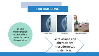 QUERATOCONO
Es una
degeneración
ectasica de la
cornea de causa
desconocida. Se relaciona con
alteraciones
mesodérmicas
sistémicas.
 