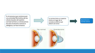 Es el proceso que comienza por
una actividad fibrinolitica de las
células basales del epitelio
corneal central y a consecuencia
de esto el estroma central se
adelgaza y se hace ectasico.
La cornea toma un aspecto
conico en lugar de la
curvatura esférica que
debería de tener .
Queratocono:
cornea conica
 