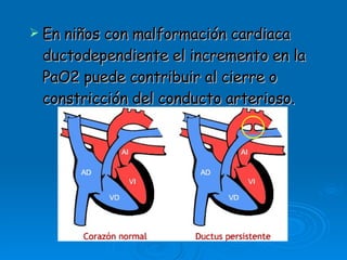 En niños con malformación cardiaca ductodependiente el incremento en la PaO2 puede contribuir al cierre o constricción del conducto arterioso.  