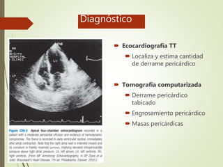 Diagnóstico
 Ecocardiografía TT
 Localiza y estima cantidad
de derrame pericárdico
 Tomografía computarizada
 Derrame pericárdico
tabicado
 Engrosamiento pericárdico
 Masas pericárdicas
 