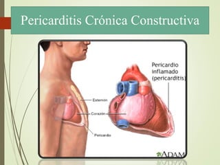 Pericarditis Crónica Constructiva
 