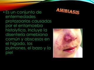 • Es un conjunto de
enfermedades
protozoarias causadas
por el entamoeba
histolytica. Incluye la
disentería amebiana
común y abscesos en
el hígado, los
pulmones, el bazo y la
piel

 