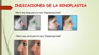 INDICACIONES DE LA RINOPLASTIA
-Nariz muy larga para la cara “Hiperproyectada”
- Nariz muy corta para la cara “Hipoproyectada”
 