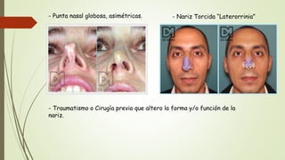 - Punta nasal globosa, asimétricas. - Nariz Torcida “Laterorrinia”
- Traumatismo o Cirugía previa que altero la forma y/o función de la
nariz.
 