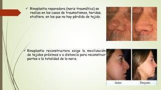  Rinoplastia reparadora (nariz traumática) se
realiza en los casos de traumatismos, heridas,
etcétera. en los que no hay pérdida de tejido.
 Rinoplastia reconstructora exige la movilización
de tejidos próximos o a distancia para reconstruir
partes o la totalidad de la nariz.
 