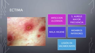 ECTIMA
INFECCION
ULCERADA
S. AUREUS
MAYOR
FRECUENCIA
MALA HIGIENE
MIEMBROS
INFERIORES
LESIÓN EN
SACABOCADOS
 