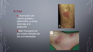 Ectima
Ulceración con
costra gruesa y
adherente, a veces
dolorosa a la
palpación
Más frecuente en
porciones distales de
las extremidades
 