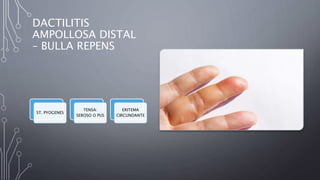 DACTILITIS
AMPOLLOSA DISTAL
– BULLA REPENS
ST. PYOGENES
TENSA:
SEROSO O PUS
ERITEMA
CIRCUNDANTE
 