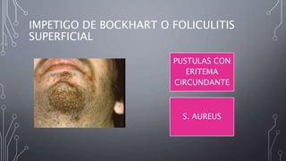 IMPETIGO DE BOCKHART O FOLICULITIS
SUPERFICIAL
PUSTULAS CON
ERITEMA
CIRCUNDANTE
S. AUREUS
 
