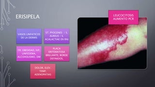 ERISIPELA
VASOS LINFATICOS
DE LA DERMIS
ST. PYOGENES / S.
AUREUS / S.
AGALACTIAE EN RN)
FR: OBESIDAD, IVP,
LINFEDEMA,
ALCOHOLISMO, DM
PLACA
ERITEMATOSA
BRILLANTE, BORDE
DEFINIDOS,
DOLOR, ELEV.
TEMP,
ADENOPATIAS
LEUCOCITOSIS
AUMENTO PCR
 