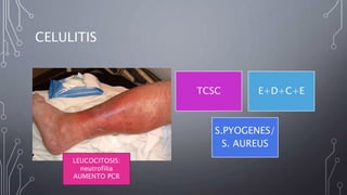 CELULITIS
TCSC E+D+C+E
S.PYOGENES/
S. AUREUS
LEUCOCITOSIS:
neutrofilia
AUMENTO PCR
 