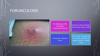 FORUNCULOSIS
FR: Obesidad, DM,
corticoides,
inmunodeficiencias
Forma en zonas pilosas
de fricción (nuca, axila)
Forúnculo: Absceso
único
Dif: Antrax conjunto de
forunculos ubicado en
región lumbar, muslos
y nuca
 