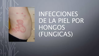 INFECCIONES
DE LA PIEL POR
HONGOS
(FUNGICAS)
 