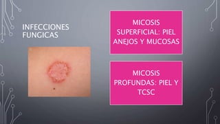 INFECCIONES
FUNGICAS
MICOSIS
SUPERFICIAL: PIEL
ANEJOS Y MUCOSAS
MICOSIS
PROFUNDAS: PIEL Y
TCSC
 