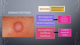 DERMATOFITOSIS
Microsporum
Trichophyton
Epidermophyton
Antropofílicos
Zoofílicos
Geofílicos
Enzimas
Proteolíticas:
Digestión de
Queratina
HOMBRES
ANIMALES
TIERRA
 