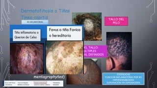 Dermatofitosis o Tiñas
Tinea capitis
Tipo ectotrix en
“placa gris”
(Microsporum)
Tipo endotrix en
“punto negro”
(Trichophyton)
Querión (T.
Verrucosum,
mentagrophytes)
NO INFLAMATORIAS
DENTRO DEL TALLO:
PLACAS MULTIPLES
BORDES MAL DEFINIDOS
TALLO DEL
PELO
ZOOFILICAS
FUNCION INFLAMATORIA POR RX
HIPERSENSIBILIDAD
SUPURACIÓN EN ESPUNADERA
INFLAMATORIAS
 