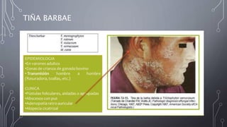 TIÑA BARBAE
 