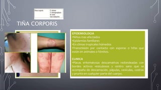 TIÑA CORPORIS
 