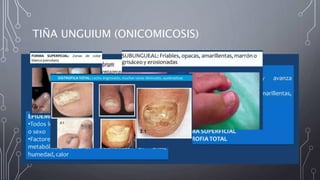 TIÑA UNGUIUM (ONICOMICOSIS)
 