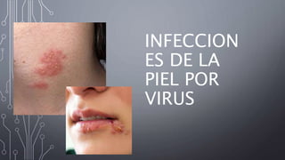 INFECCION
ES DE LA
PIEL POR
VIRUS
 