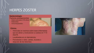 HERPES ZOSTER
 