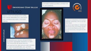 VITILIGO
 