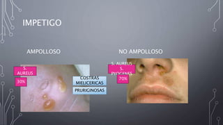 IMPETIGO
AMPOLLOSO NO AMPOLLOSO
S.
AUREUS
S. AUREUS
S.
PYOGENES
30%
70%
COSTRAS
MIELICERICAS
PRURIGINOSAS
 
