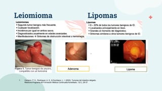 Leiomioma Lipomas
1. Centeno, P. G., Rodríguez, A. S., & Escribano, L. I. (2020). Tumores del intestino delgado.
Medicine-Programa de Formación Médica Continuada Acreditado, 13(1), 26-37.
 
