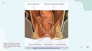 Nelson, R. (2002). Anorectal
abscess fistula: what do we
know?. Surgical Clinics, 82(6),
1139-1151.
 