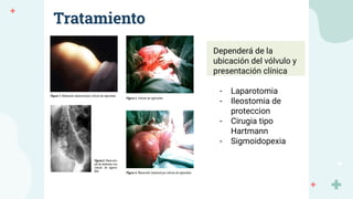 Tratamiento
Dependerá de la
ubicación del vólvulo y
presentación clínica
- Laparotomia
- Ileostomia de
proteccion
- Cirugia tipo
Hartmann
- Sigmoidopexia
 