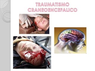 Traumatismo Craneoencefalico TCE
