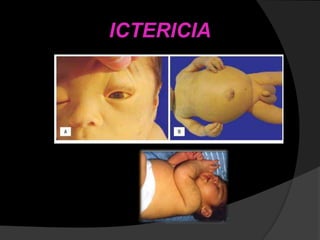 ICTERICIA
 